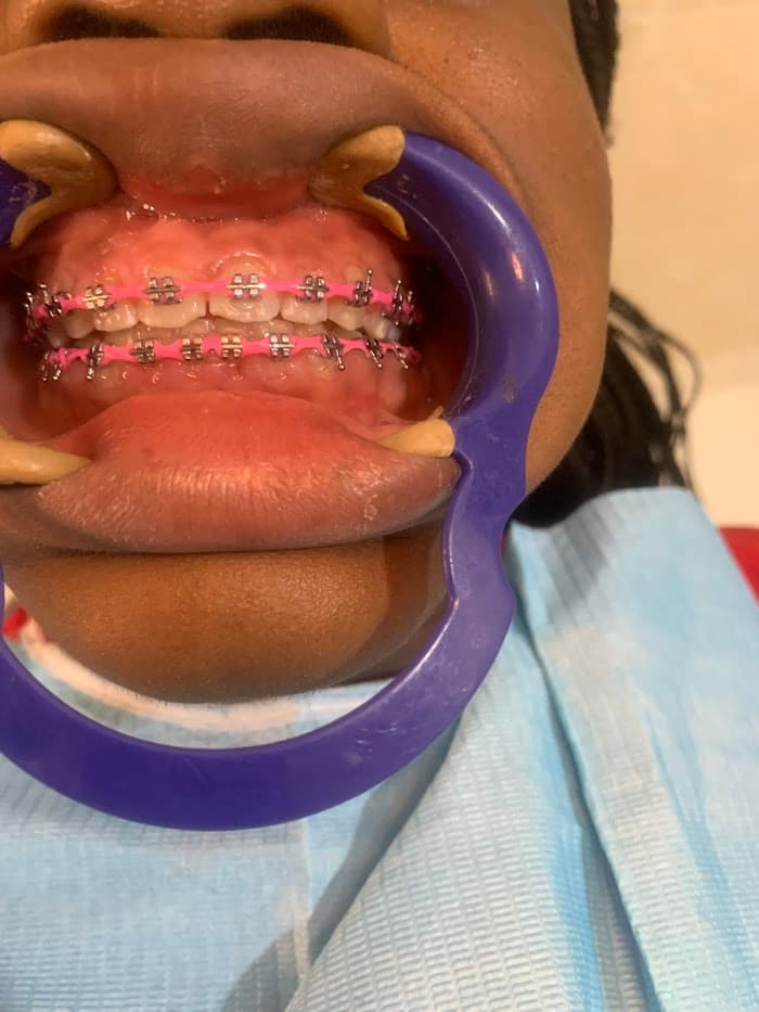 Dental Procedure
